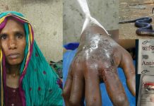 বিষাক্ত সর্প দংশন এবং জীবন ফিরে পাওয়া ফিরোজা বেগমের গল্প বিষাক্ত সর্প দংশন