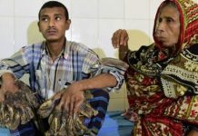 বৃক্ষমানব আবুল বাজানদারের ব্যাপারে ঢামেক চিকিৎসকরা যা বললেন বৃক্ষমানব আবুল বাজানদারের ব্যাপারে ঢামেক চিকিৎসকরা যা বললেন